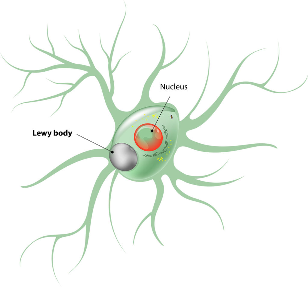 Lewy Body - Dementia