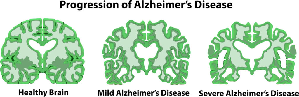 Alzheimer's Disease Progression